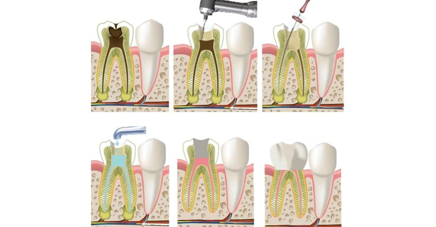 endodontist procedures1
